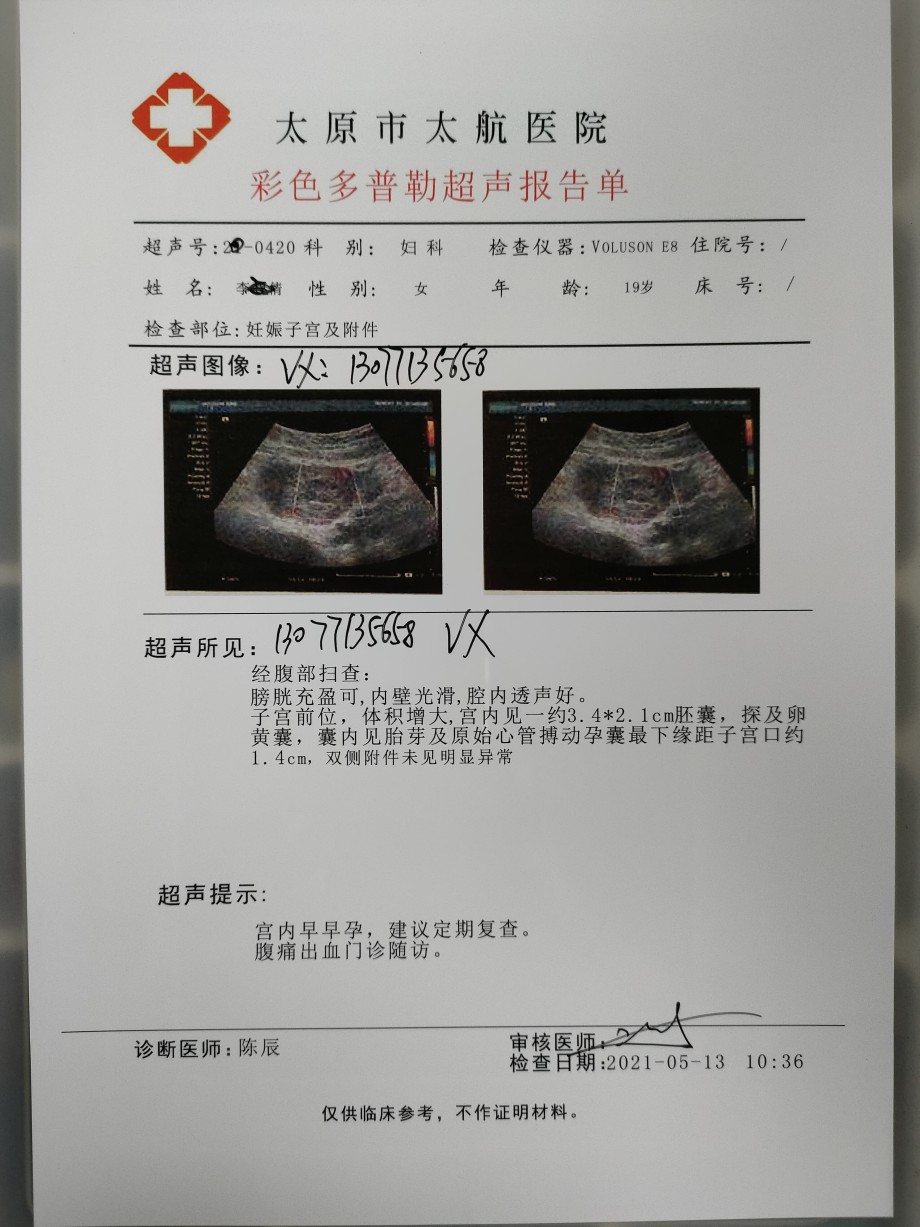 怀孕十周四天的b超想知道男女孕10周4天b超图孕10周b超显示已成型