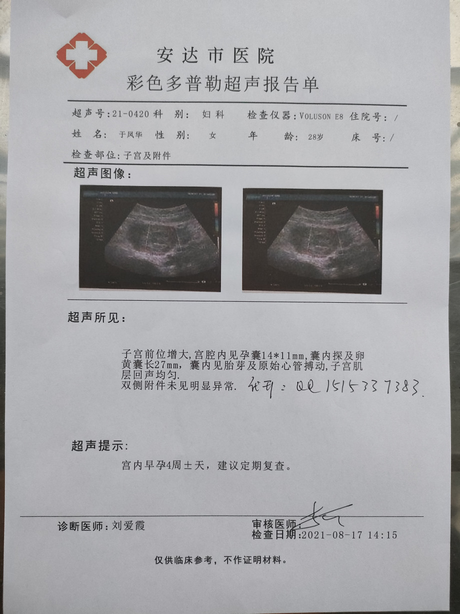 指点怀孕b超报告早孕双胞胎b超图早孕双胞胎b超异卵双生怀照了b超还是