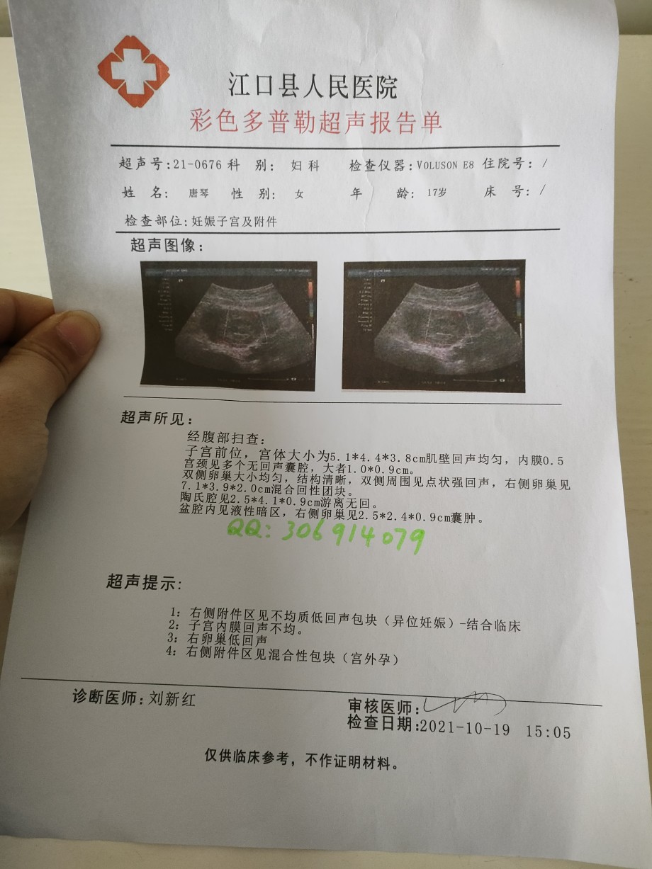 双胞胎b超彩超报告早早孕b超阑尾炎抑郁证明住院记录证明单子押金单