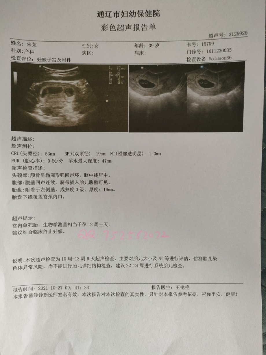 1个月怀孕三胞胎妊娠卫生部发行的怀孕一个月b超单怀孕b超单子怀孕b超