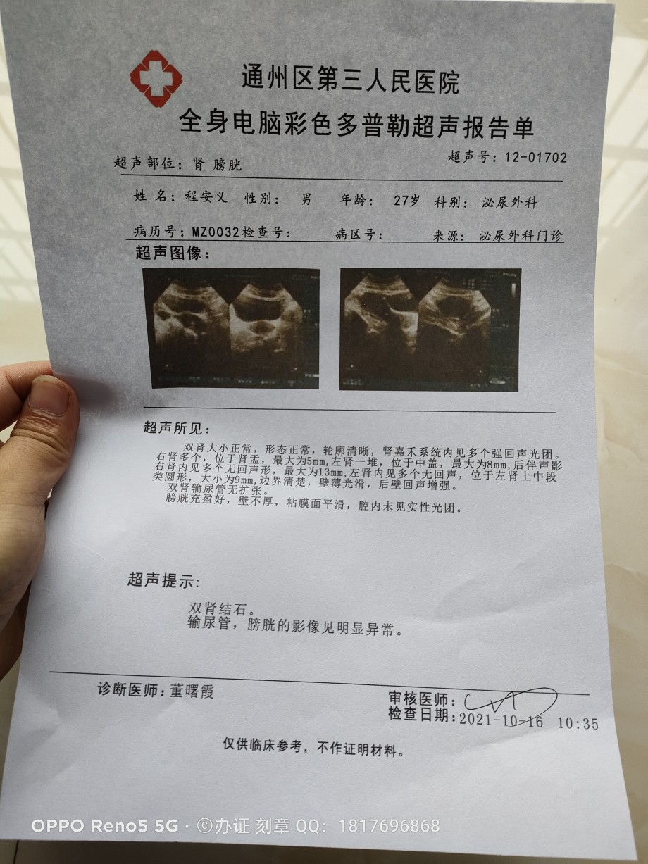 是宫外孕吗宫外孕b超单确诊图片一个月血检hcg先兆流产早孕b超单孕